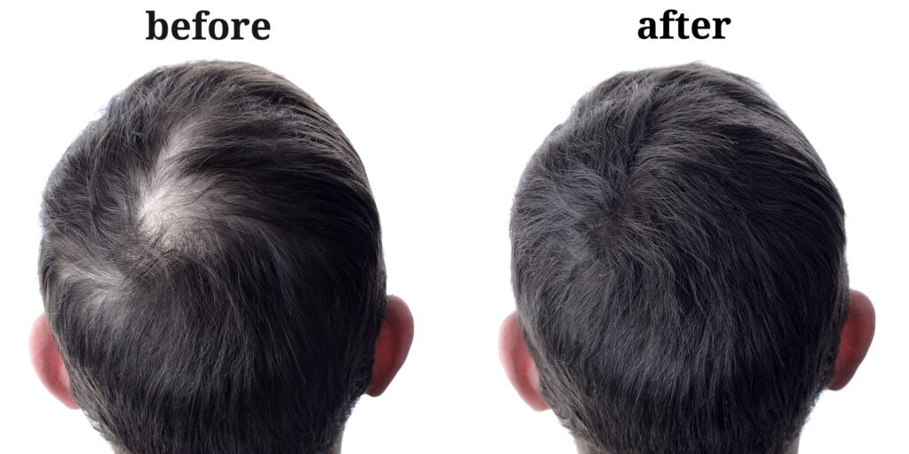 Top 10 Natural Remedies for Hair Regrowth in Men / Brain Of Interest