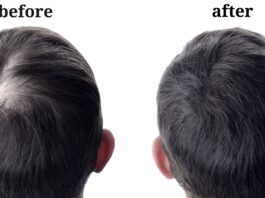 Top 10 Natural Remedies for Hair Regrowth in Men / Brain Of Interest